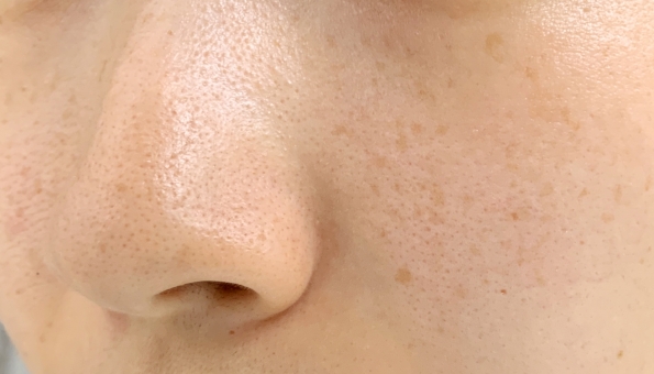 30代になると毛穴のトラブルが増える