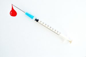 注入によるたるみ治療「脂肪溶解注射」