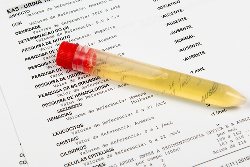 Test,Tube,With,Urine,Analysis,,Over,A,Paper,With,The